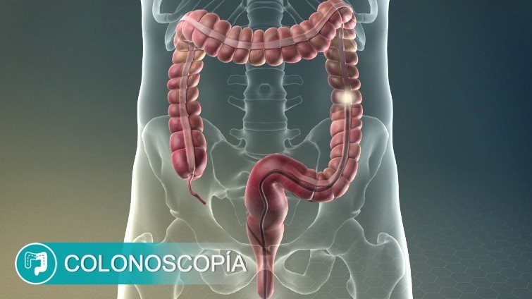 Colonoscopía en Quito Dr. Xavier Obando Examen