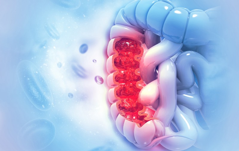 Cáncer de colon recto especialista cirujano general hospital metropolitano quito Dr. Xavier Obando