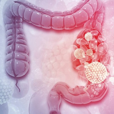 cancer-de-colon-especialista-quito