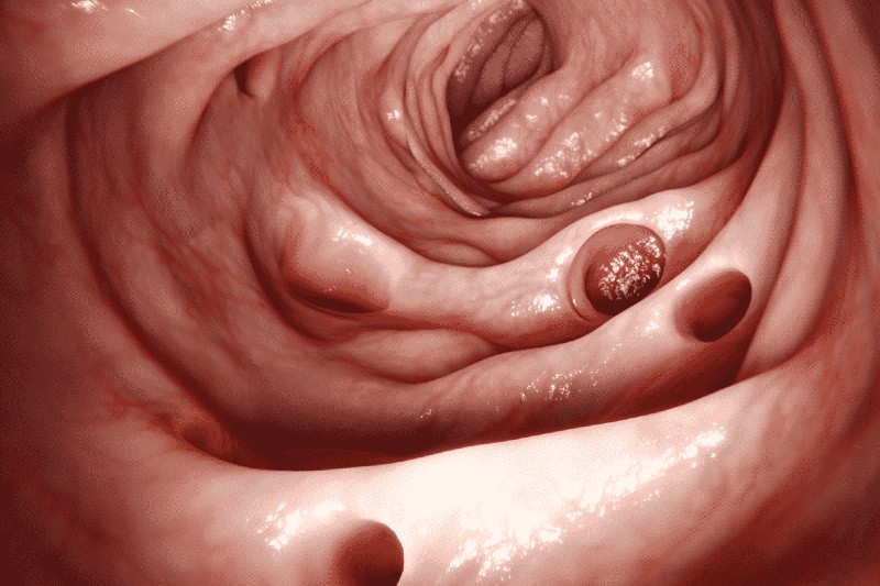enfermedad diverticular especialista quito ecuador Dr. Xavier Obando Cirujano Coloproctólogo
